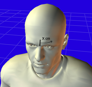 X distance marked from the midline across the forehead