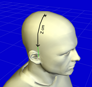 Z distance marked from the vertex toward the ear